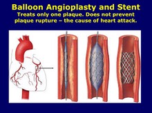 Angioplasty and Stent