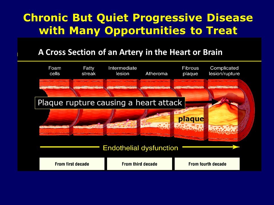 Atherosclerosis is a Naturally Progressive Disease 