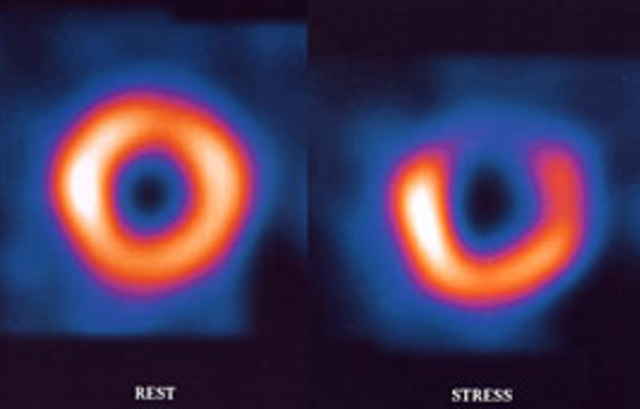Capture - Abnormal nuclear scan