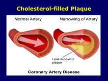 Cholesterol-filled Plaque