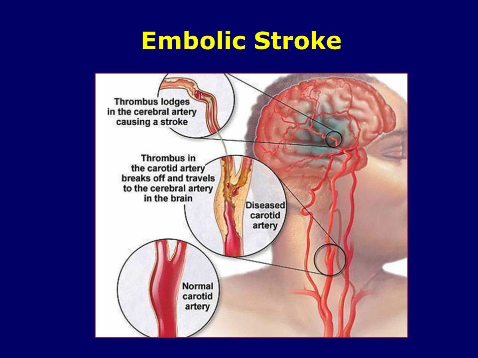 Embolic Stroke