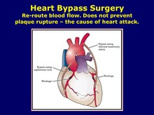 Heart Bypass