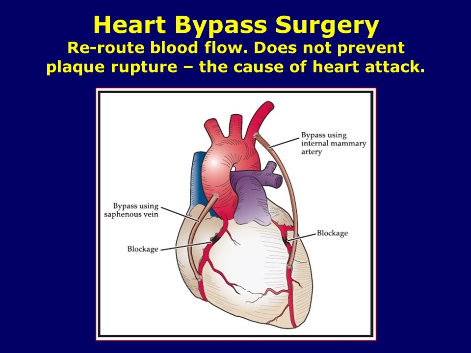 Heart Bypass