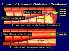Impact of Advanced Cholesterol Treatment