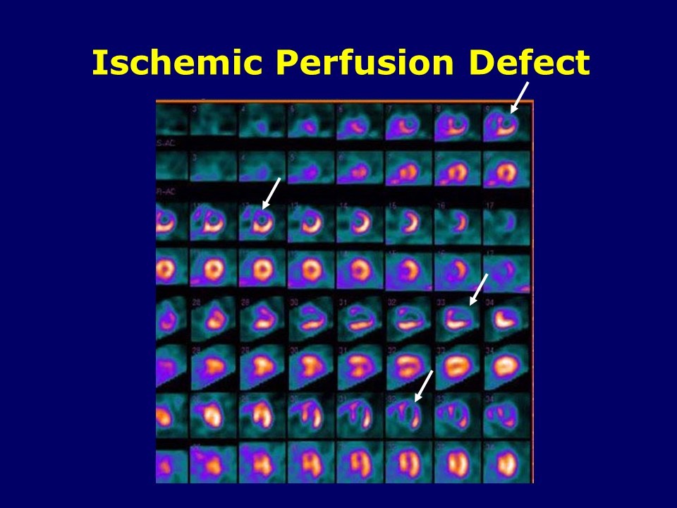 Ischemic Perfusion Defect