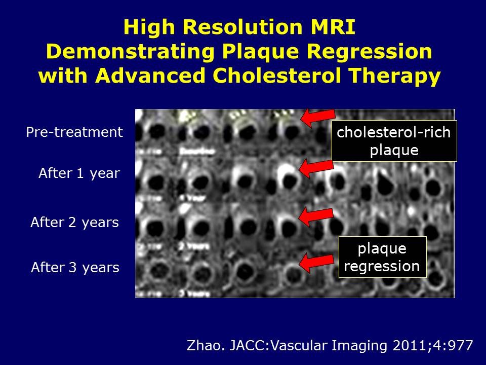 MRI Plaque Regression