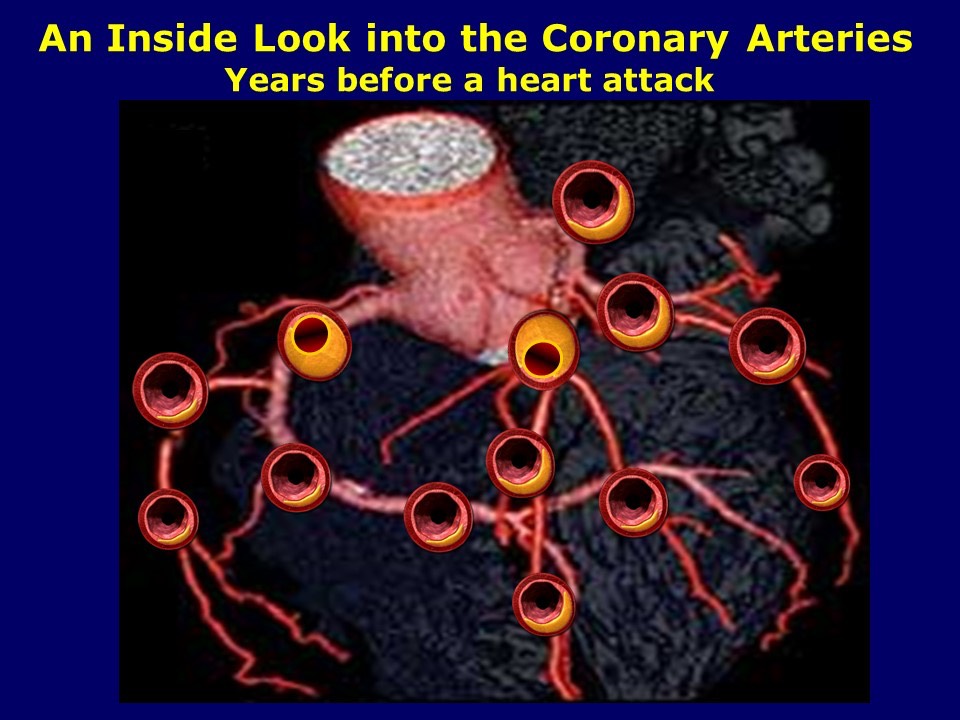 Multiple Coronary Plaques