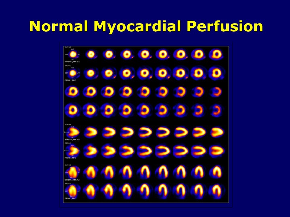 Normal perfusion