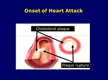 Plaque Rupture Front View