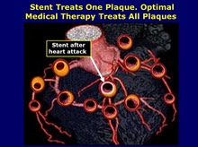 Stent Treats One Plaque, Medical Therapy Treats All Plaques