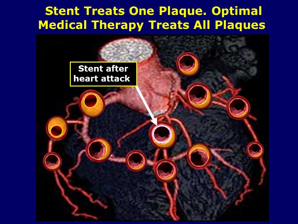 Stent Treats One Plaque, Medical Therapy Treats All Plaques