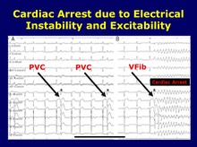 Ventricular Fibrillation