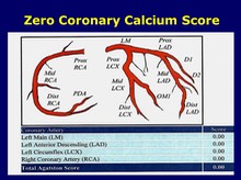Zero Coronary Calcium Score