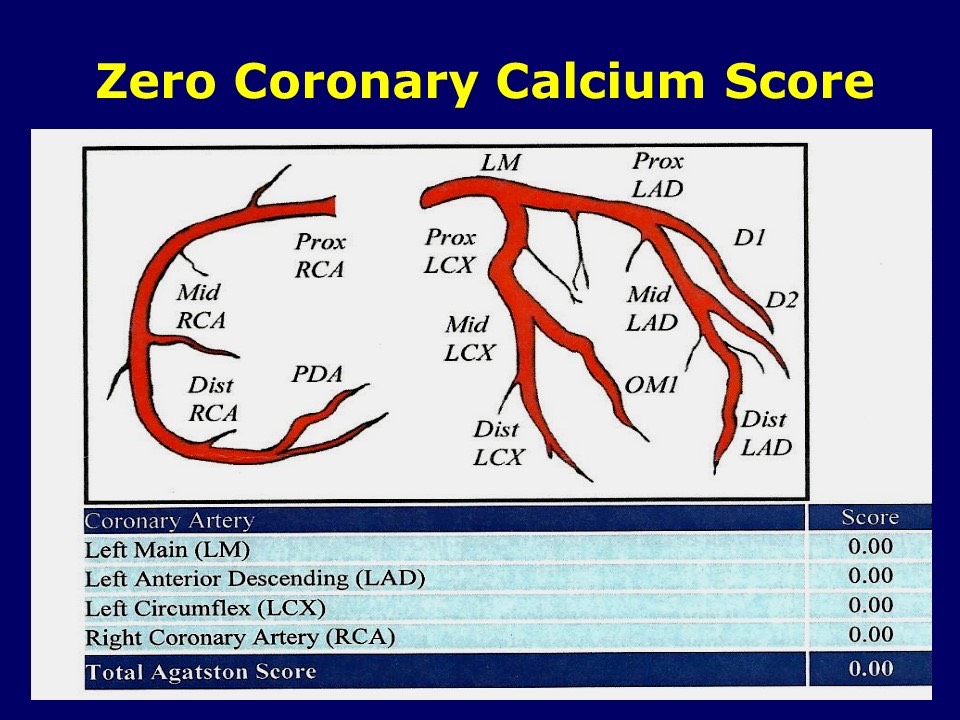 Zero Coronary Calcium Score